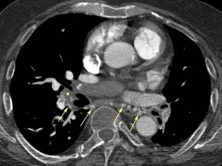 Chronic PE - Chronic Pulmonary Embolism - radRounds Radiology Network