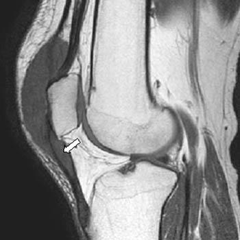 Unsaturated fats have fewer hydrogen atoms than saturat. Pigmented Villonodular Synovitis - Radsource