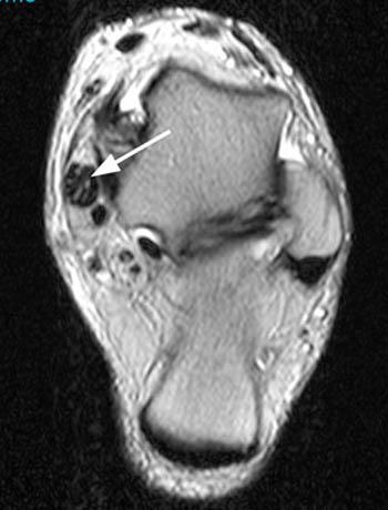 Tibialis posterior tendon mri
