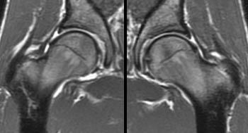 Unfortunately with age, not only is there an increase in responsibility b. Femoroacetabular Impingement - Radsource