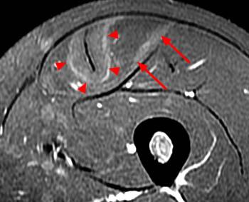 They're made up of five different muscles. MRI of Rectus Femoris / Quadriceps Injury - Radsource