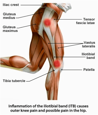 However, there are many back muscles which can cause pain . Does the outside of your knee hurt, especially when you