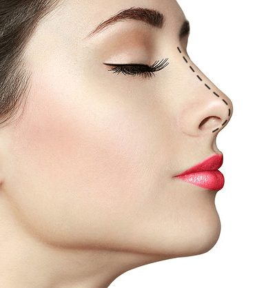 rinoplastia