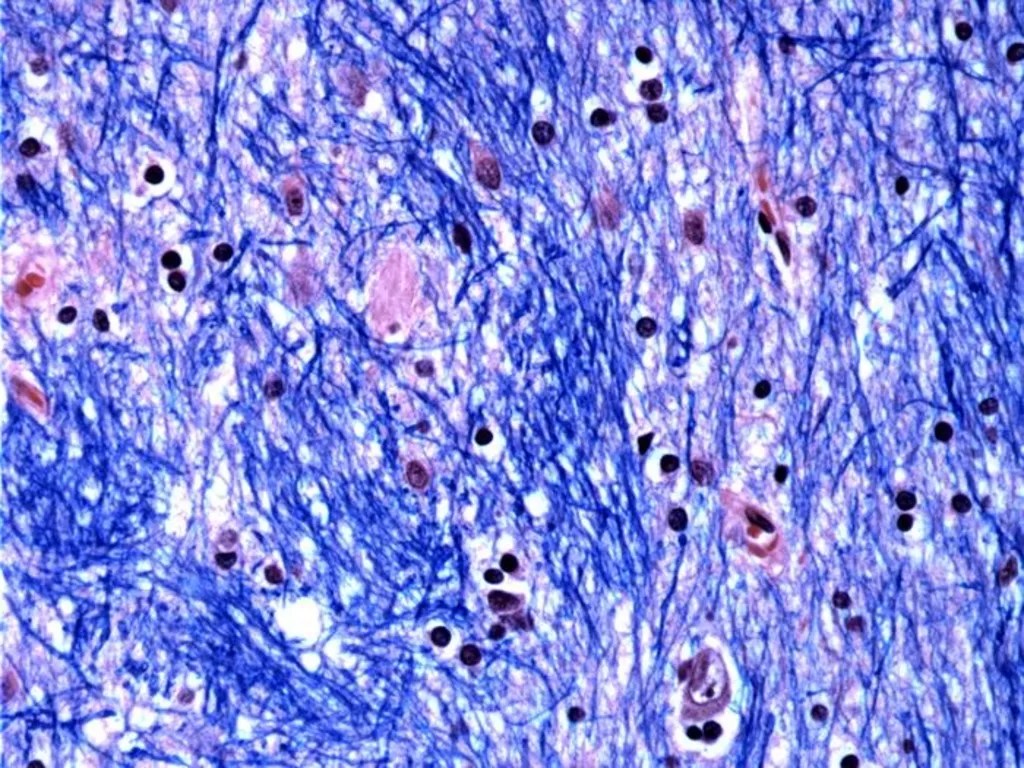 Groundbreaking Discovery: How Genetic Mutation Fuels Huntington’s Disease Over Decades