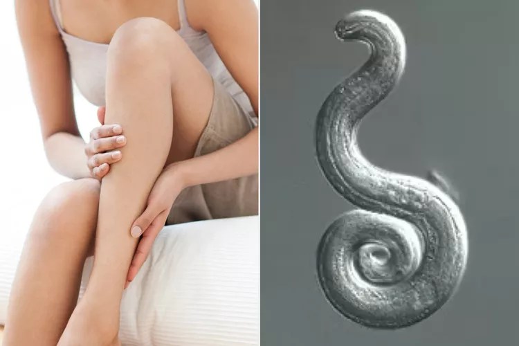 Woman Contracts Brain Worms from Vacation: How Sushi and Salad Led to a Burning Sensation in Her Legs