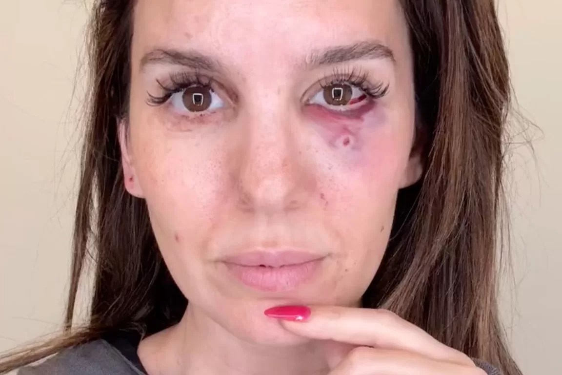 Christy Carlson Romano Injured in Eye Shooting Incident During Husband’s Birthday Celebration