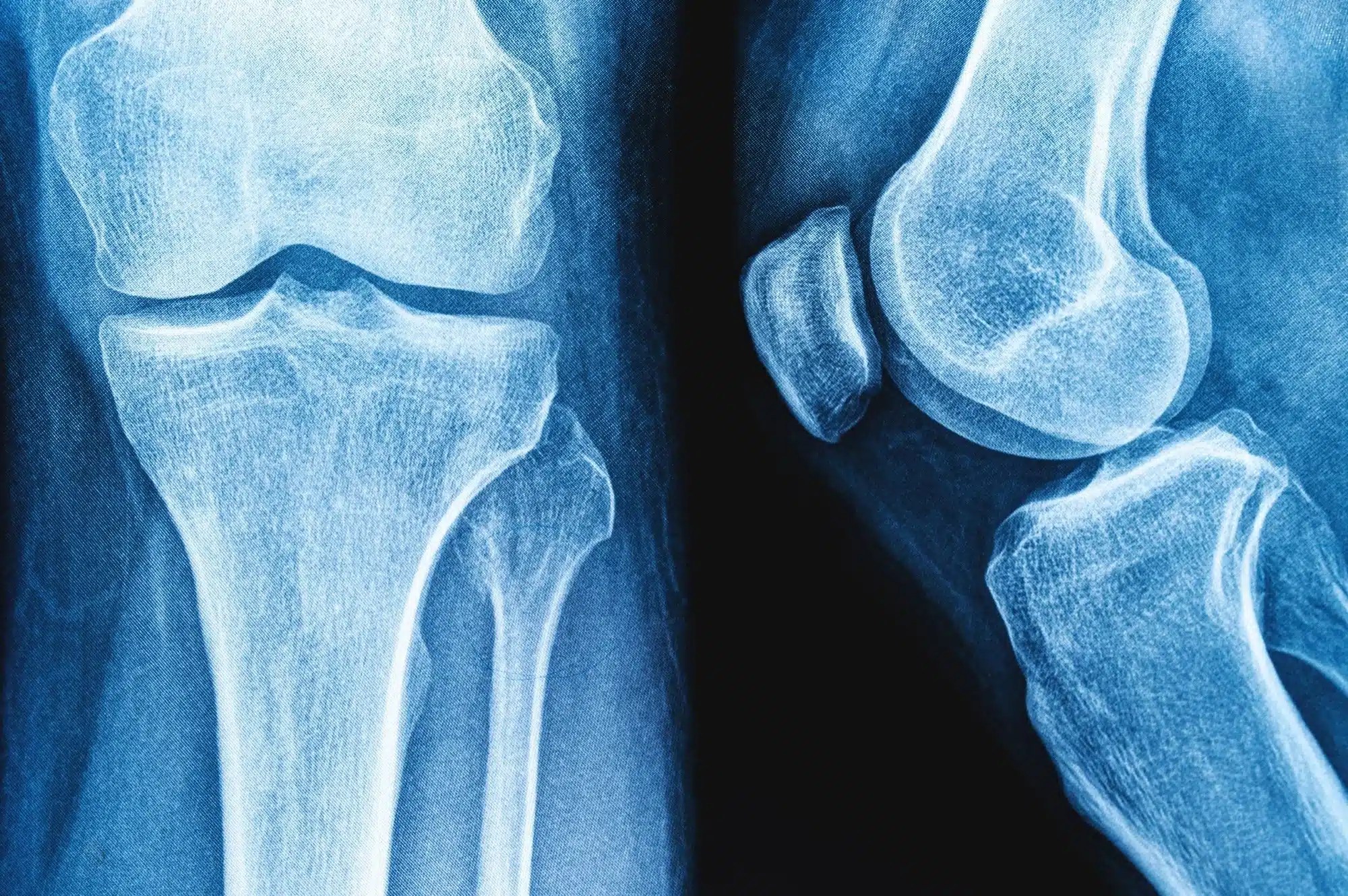 Do GLP-1 Weight Loss Drugs Increase Osteoporosis and Gout Risk? What New Research Reveals Do GLP-1 Weight Loss Drugs Increase Osteoporosis and Gout Risk? What New Research Reveals