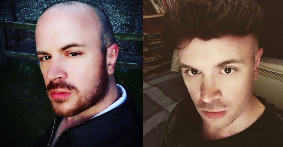REVIEW | Hair Replacement Hub, Hair today, gone tomorrow, back again today 1