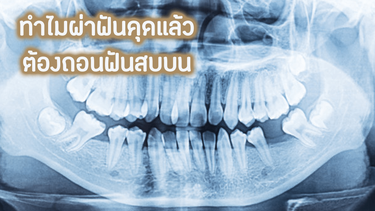 ฟันสบบน