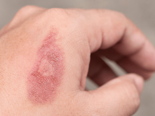 hand with 1st degree burn
