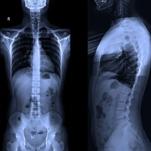 Spinal X-ray displayed in the Recupera DICOM imaging viewer