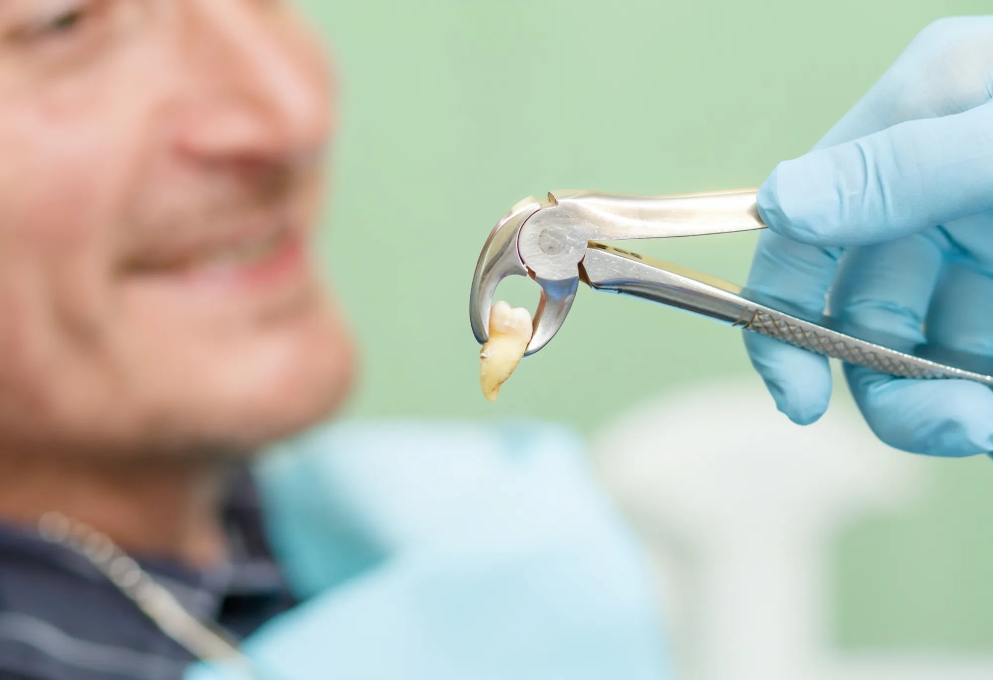 Wisdom tooth surgical extraction in Sussex