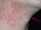 Pseudofoliculitis
