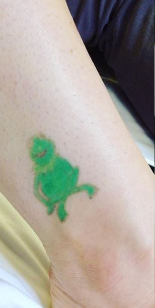 What To Know About Color Tattoo Removal | Removery 611_x_308_jpg