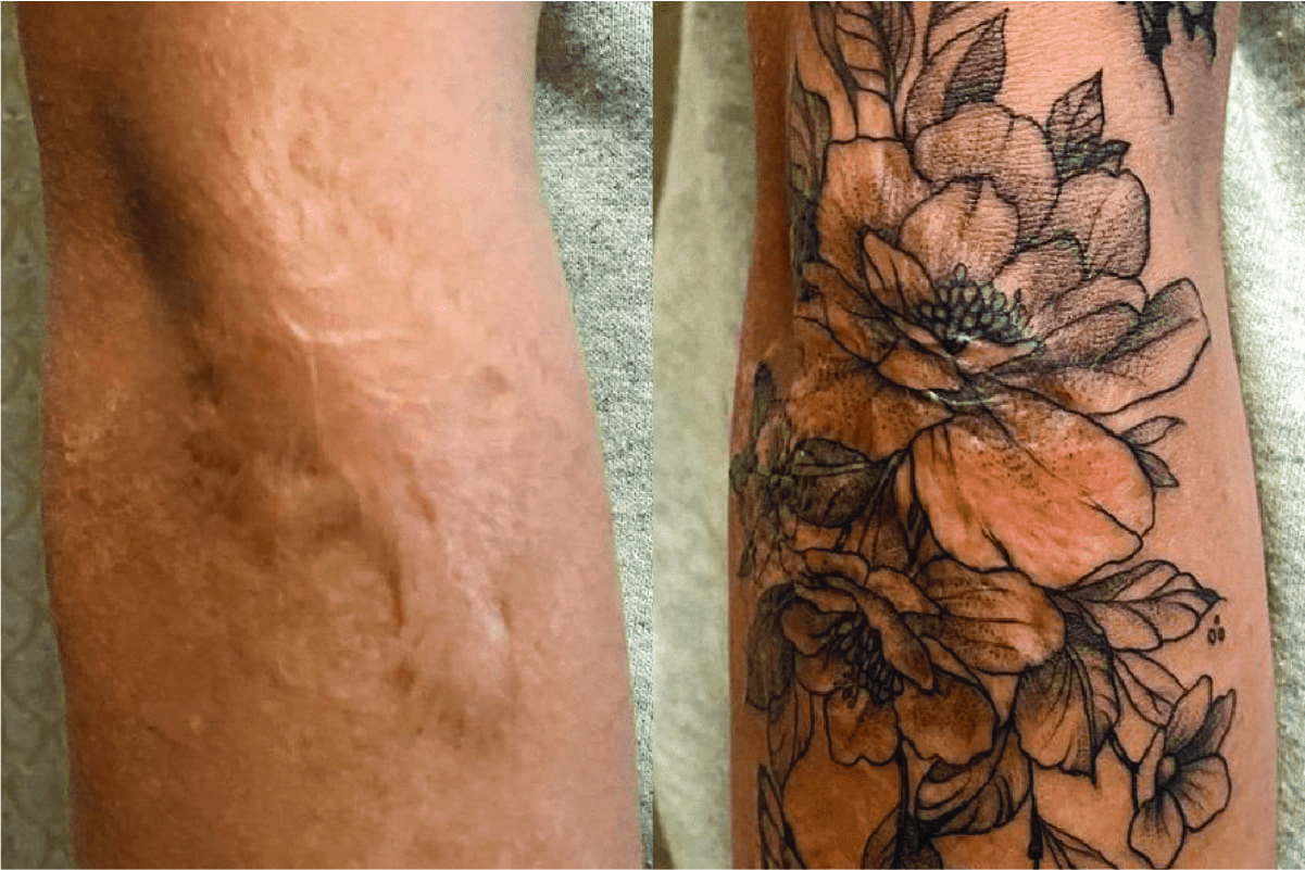 What To Know About Using Tattoos To Cover Scars | Removery 801_x_1201_jpg