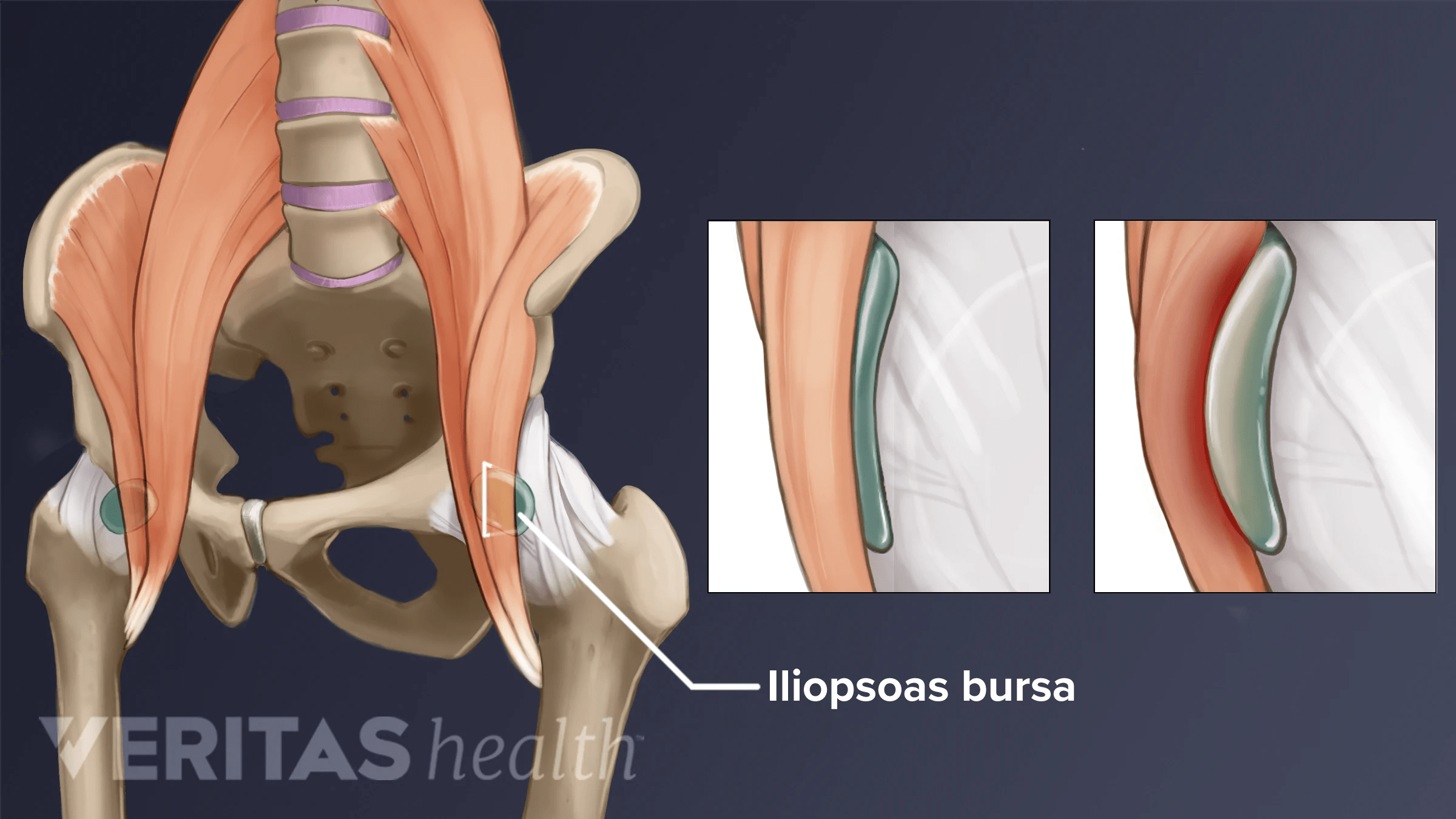 Hip Bursitis Symptoms