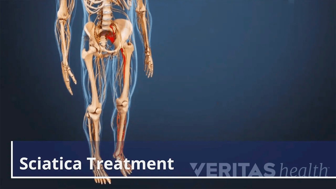 Sciatica Treatment Video