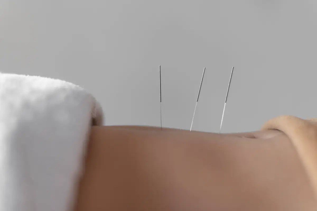 How Does Acupuncture Work