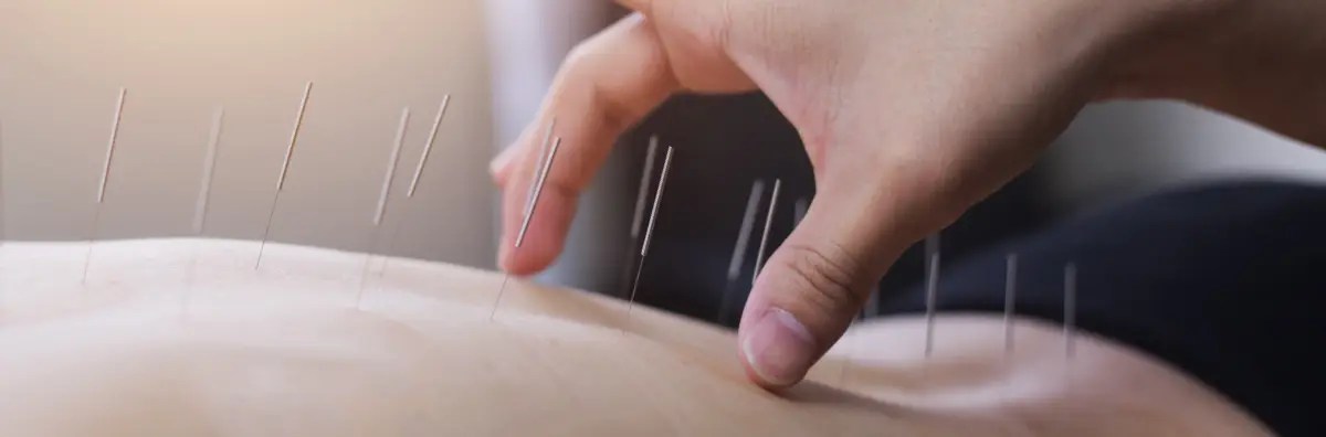 What is Acupuncture