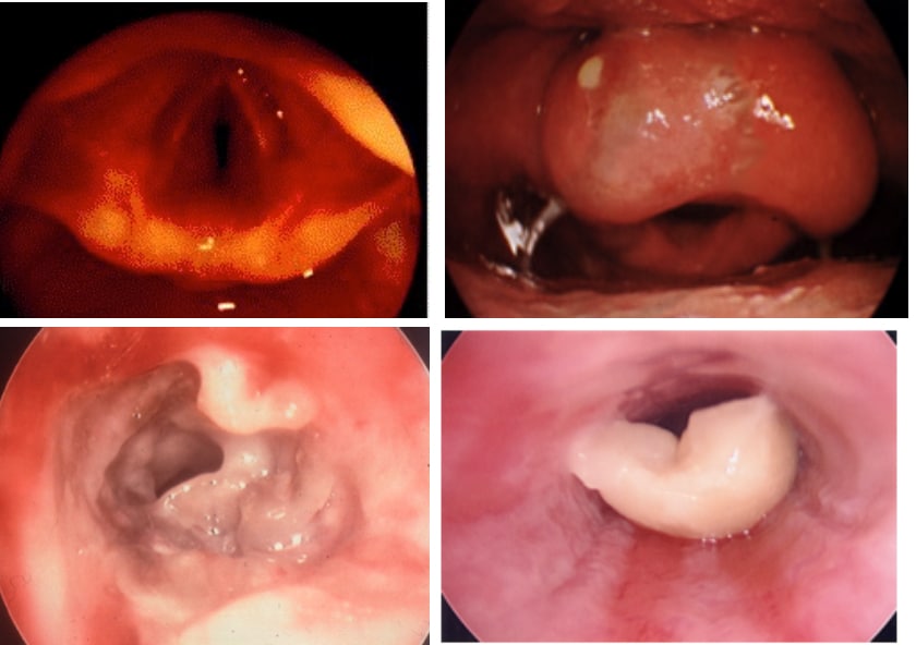 Despite this, if you download the necessary files with internet download manager activated with a working idm . Acute upper airway obstruction in children : WFSA - Resources