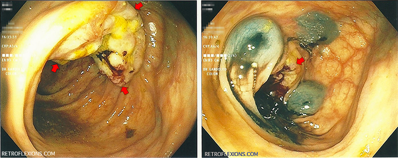 Colonoscopy and sigmoidoscopy are procedures that let your doctor look inside your large inte. Retroflexions Com Gastroenterologists Are Tattoo Artists Of The Colon