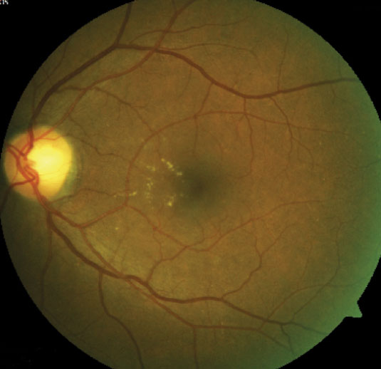 Interventions to treat and resolve diabetic macular edema include a less intense form of laser treatment called focal laser and the same intravitreal injections that are used to treat proliferative diabetic retinopathy. My Patient Has Diabetic Retinopathy...Now What?