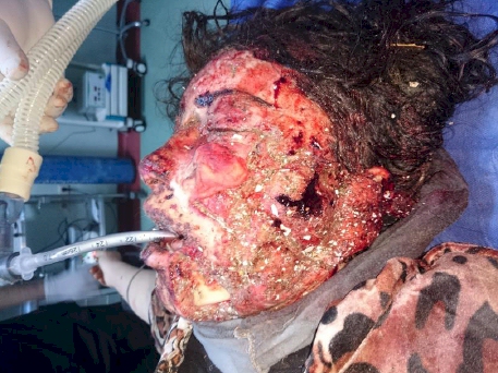 Mosul survivors on their way to recovery.