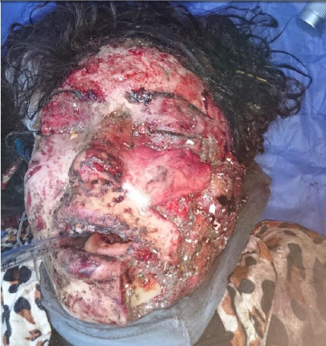 Mosul survivors on their way to recovery.