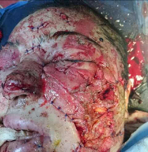 Mosul survivors on their way to recovery.