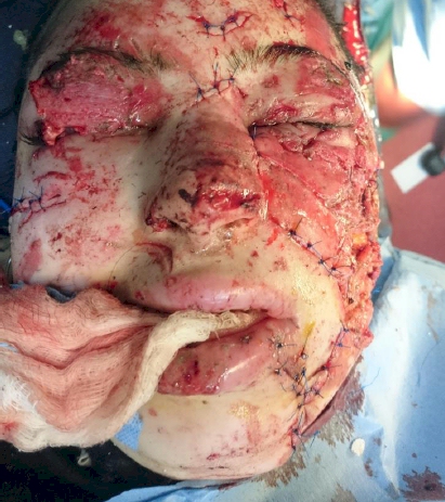 Mosul survivors on their way to recovery.