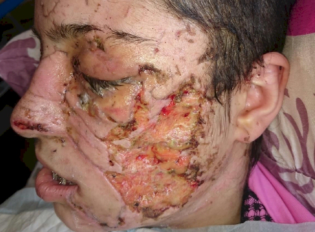 Mosul survivors on their way to recovery.