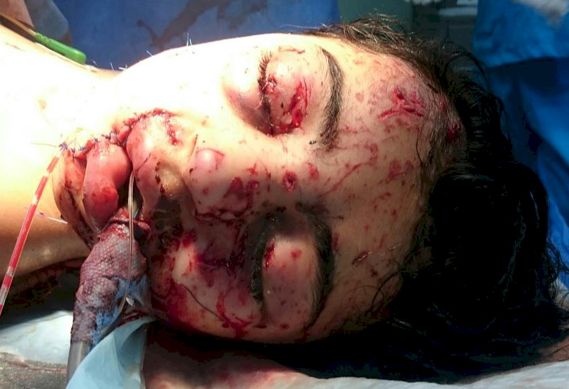 Mosul survivors on their way to recovery.