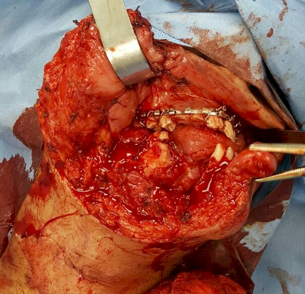 Mosul survivors on their way to recovery.