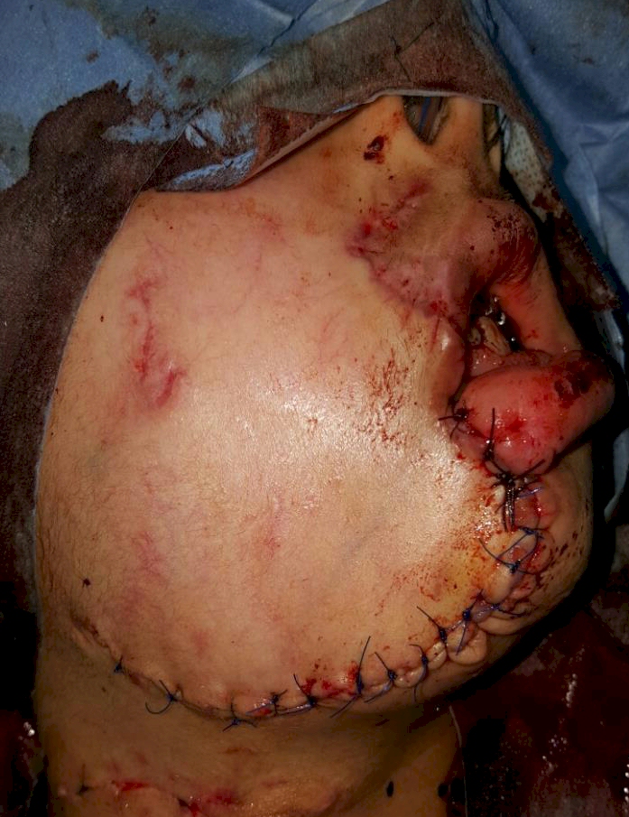 Mosul survivors on their way to recovery.