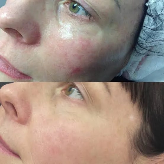 Redness or broken capillaries (before/after)