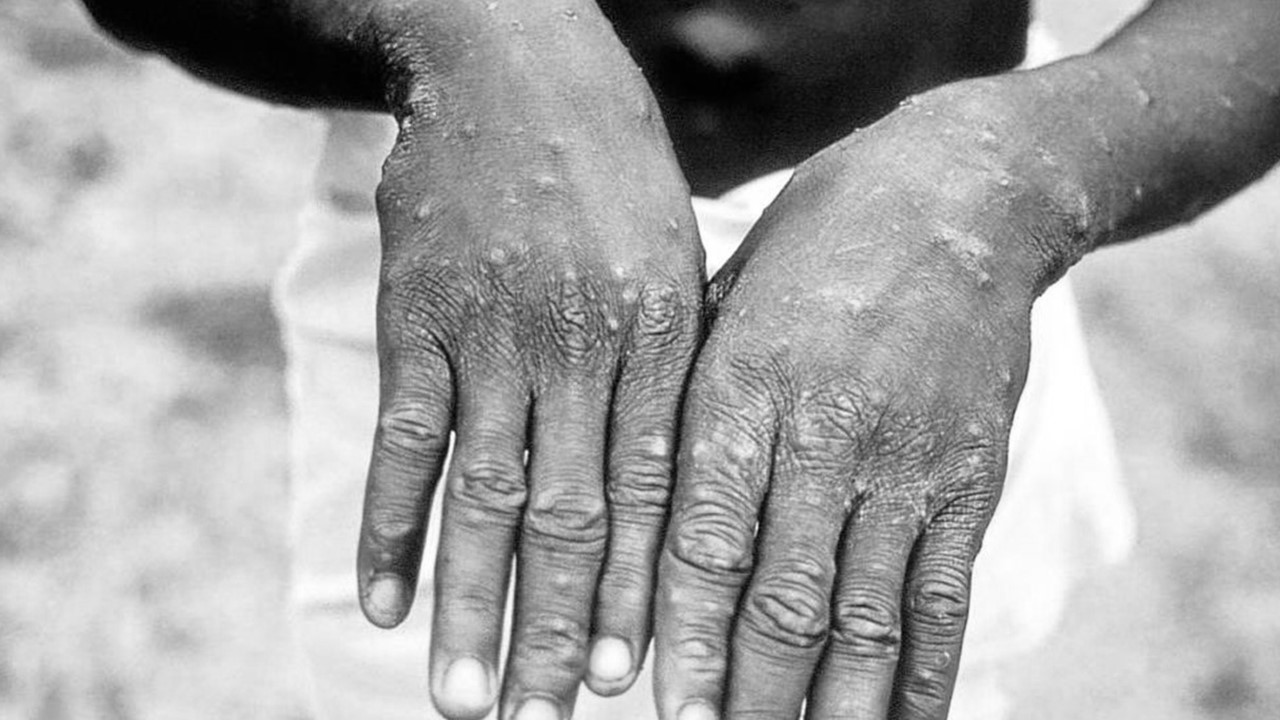US, nagdeklara na ng public health emergency laban sa monkeypox virus