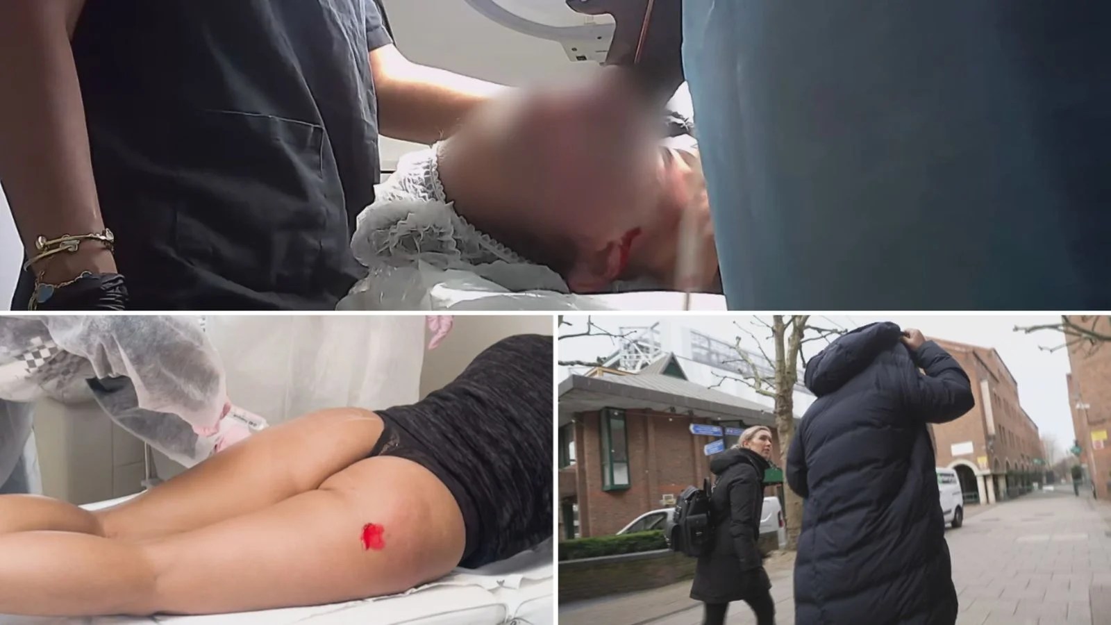 UK Moves to Ban High-Risk Cosmetic Procedures Like Brazilian Butt Lifts