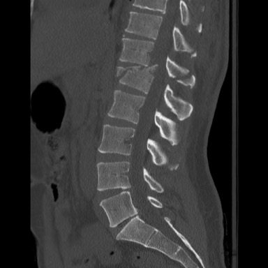 Initial X-Ray