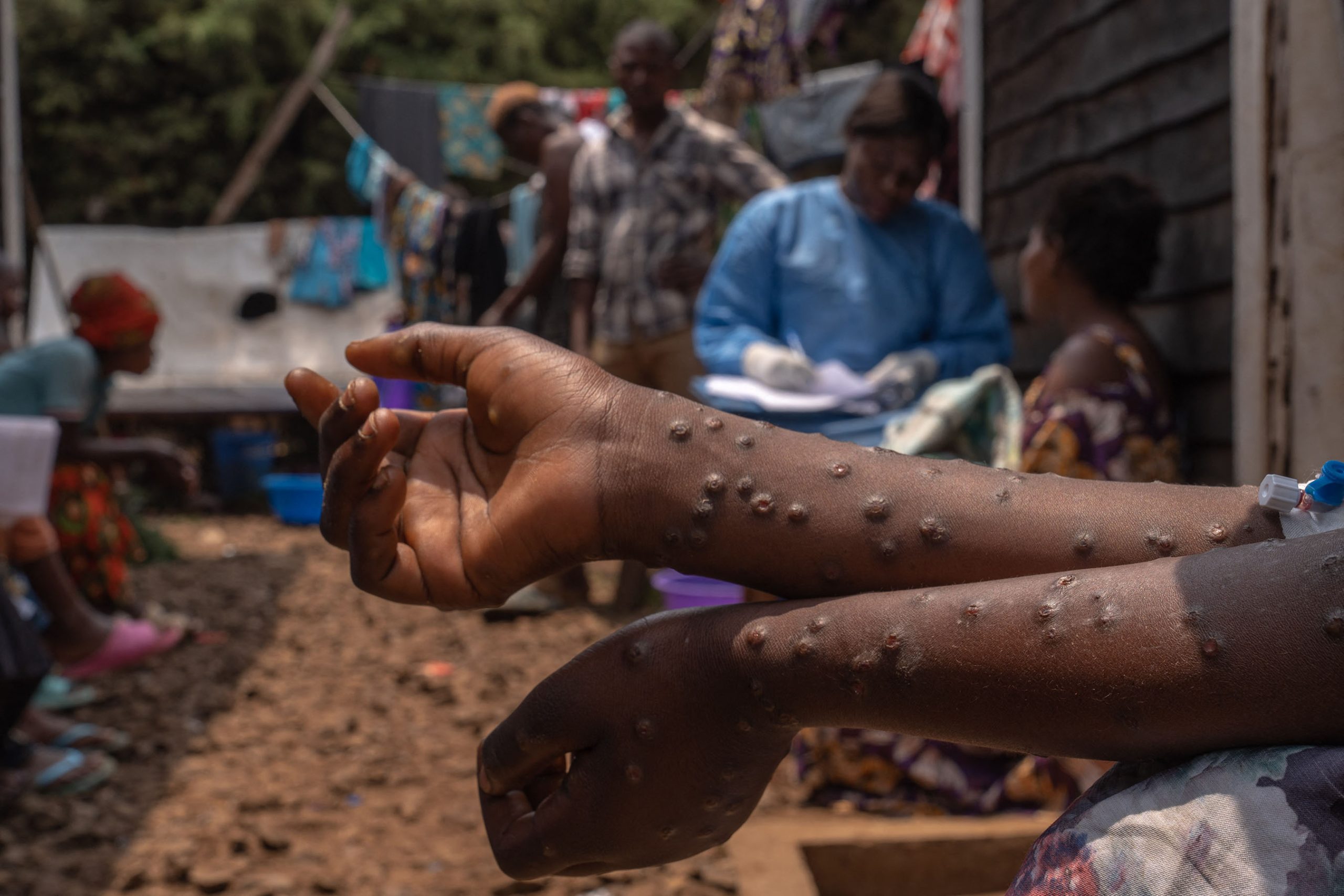 MPOX : Le Nord-Kivu atteint 1 284 cas confirmés, dont 138 actifs