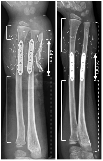 пересадка рук