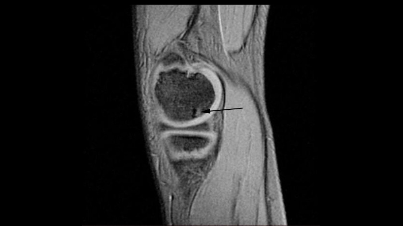 The ROCK Group: 15 Years of Chasing Down OCD of the Knee