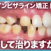 baixar 他院から悩みを抱えてきた症例！治療前後や最中でも治せますか？【審美歯科 歯列矯正 歯並び インビザライン】 mp3