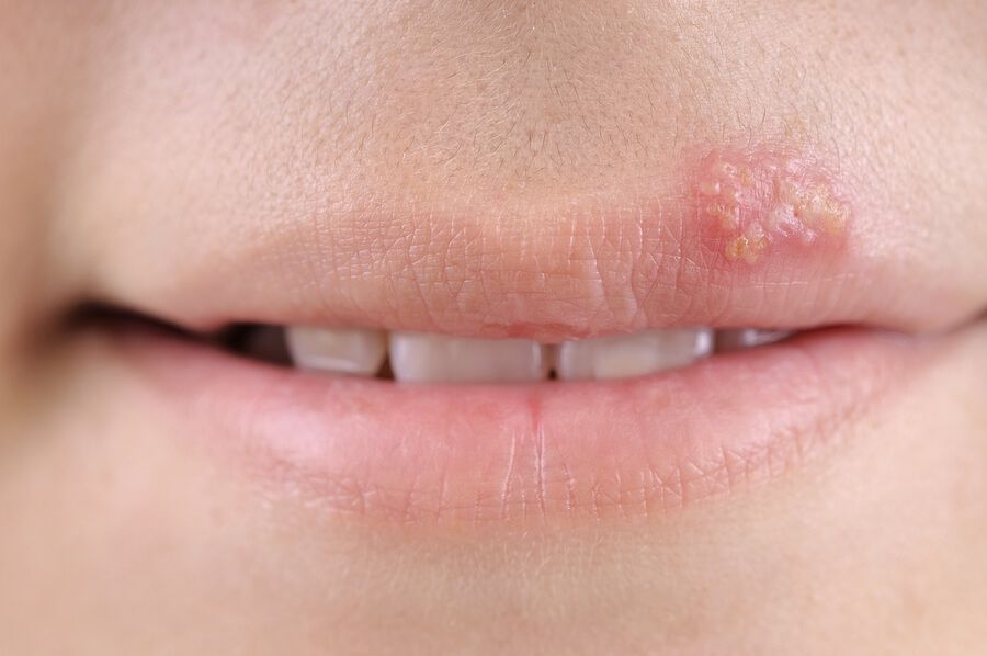 pic How To Get Rid Of A Cold Sore Fast On Your Lip plushcare