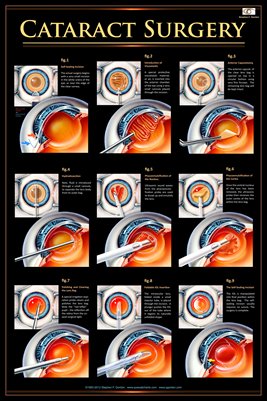 eye wall charts cataract surgery v1 eye wall chart