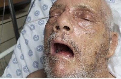 Brutal farm attack at Hartbeespoort farm, elderly man still critical after 5 weeks