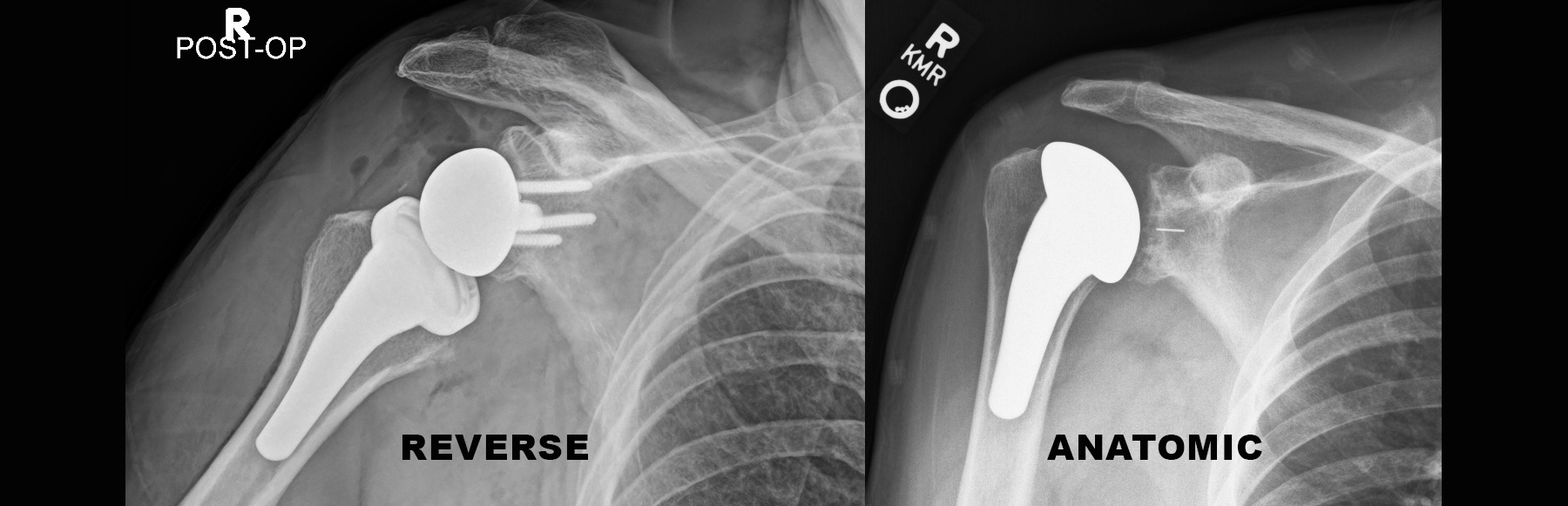 Anatomic vs Reverse Shoulder Replacement: How Surgeons Decide