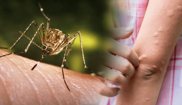 Japanese Encephalitis