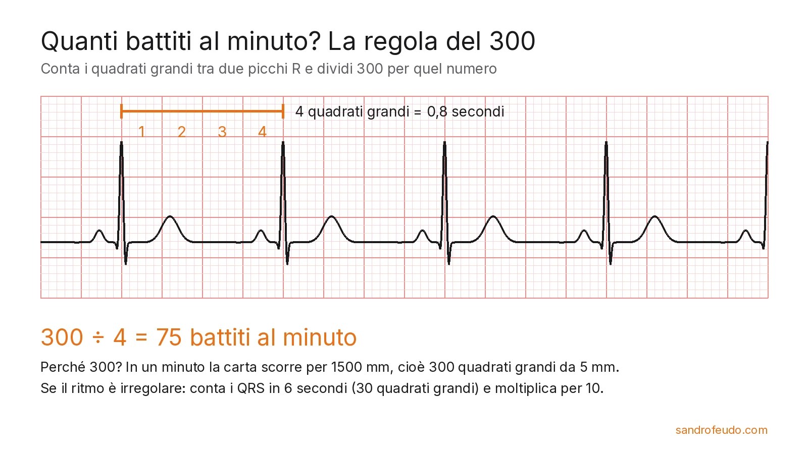 Striscia ECG con quattro quadrati grandi tra due picchi R e il calcolo 300 diviso 4 uguale 75 battiti al minuto
