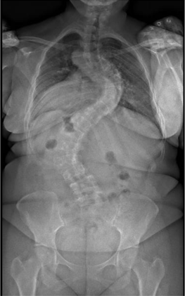 Standing X-ray showing severe untreated adult scoliosis