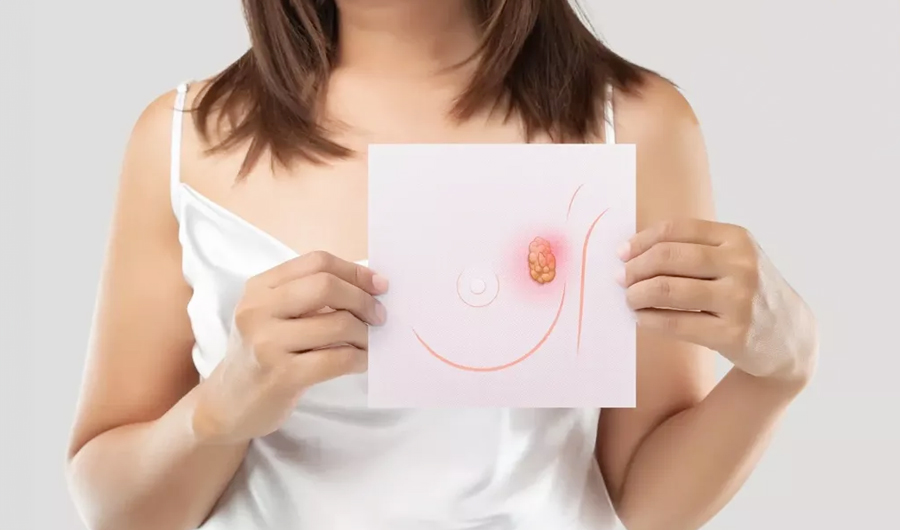 دراسة: ارتداد سرطان الثدي يرتبط بالحرمان الاجتماعي والاقتصادي